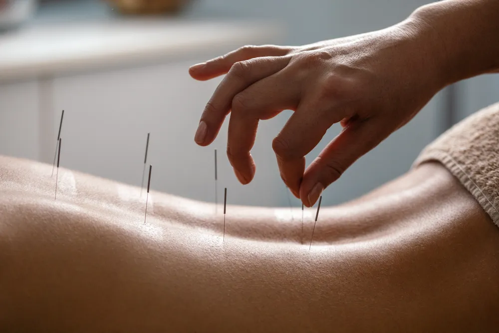 Traditional Chinese Acupuncture and Cupping therapy
